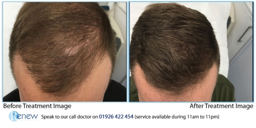 Hair transplant treatment