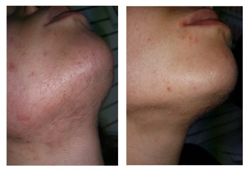 Laser Hair Removal at LaserWise Cardiff