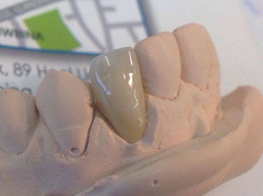 Zirconia Crown