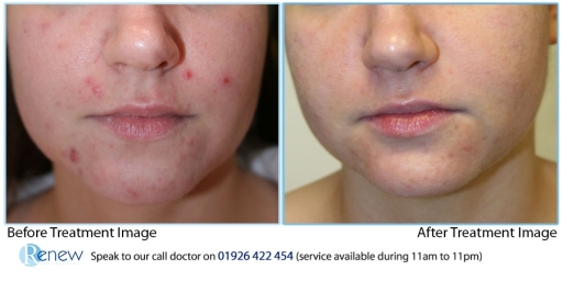Acne treatment