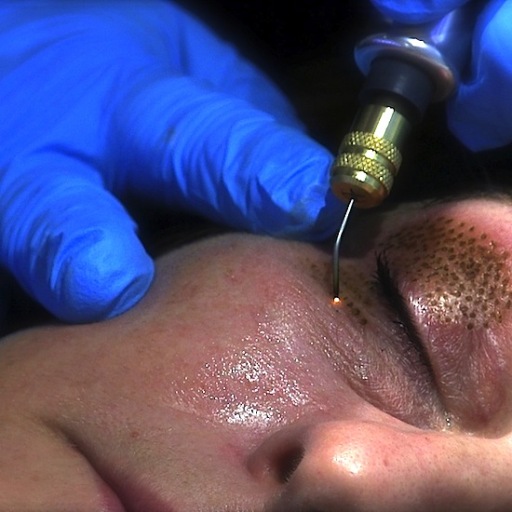 Fibroblast Non-surgical Skin Tightening