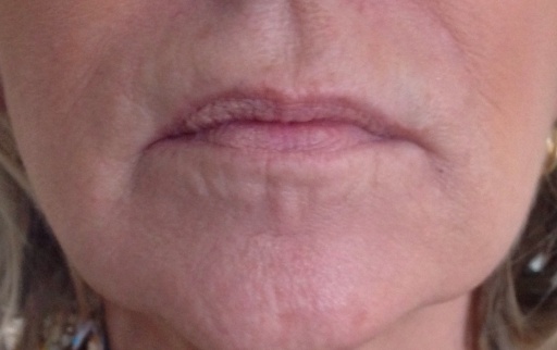 Before Lip Filler