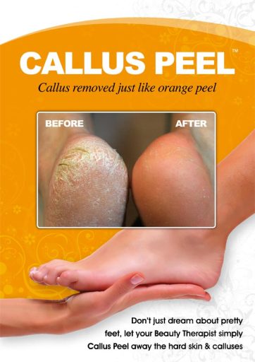 Callus Peel Treatment