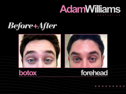 Botox - before and after