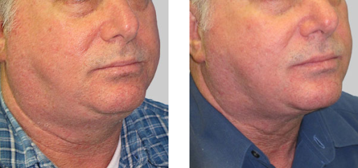 EXILIS - Great for melting neck fat!