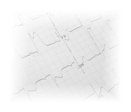 Chest pain ECG