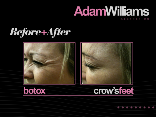 Botox - before and after