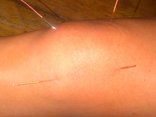 Acupuncture for knee pain