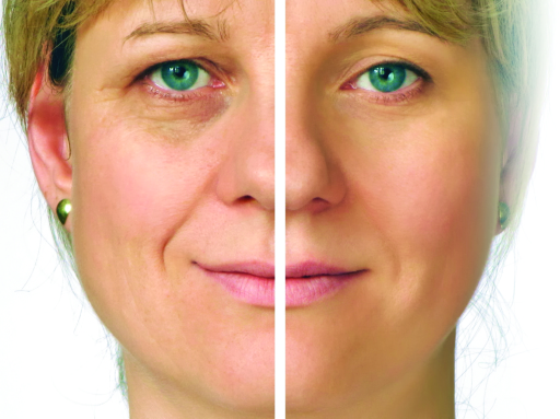 CACI Non Surgical Face Lift