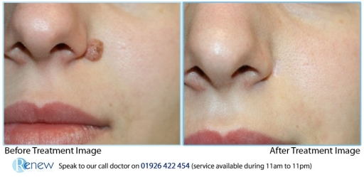 Laser mole removal treatment