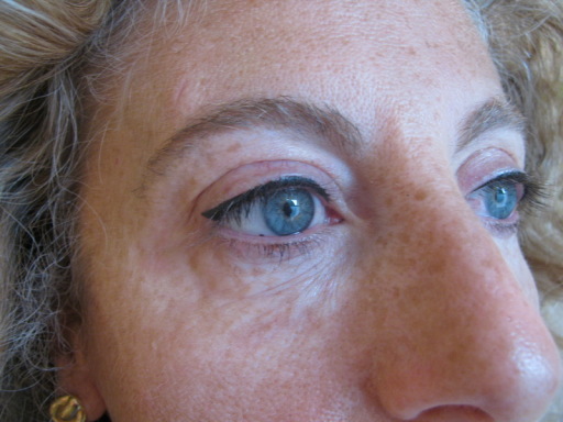 Picture of Small Latino Eyeliner after procedure in Black colour