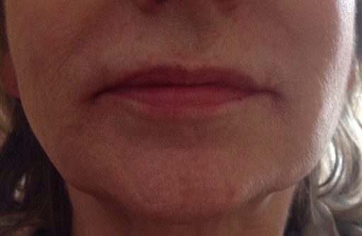 After Lip Filler
