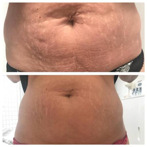 4D ultrasonic cavitation