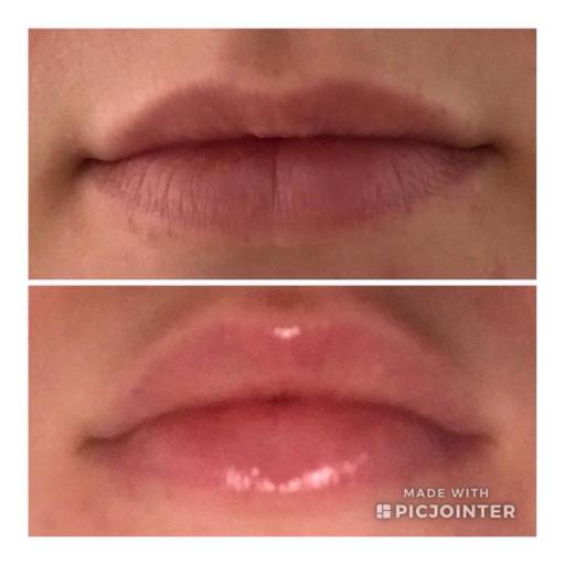 Lip plump