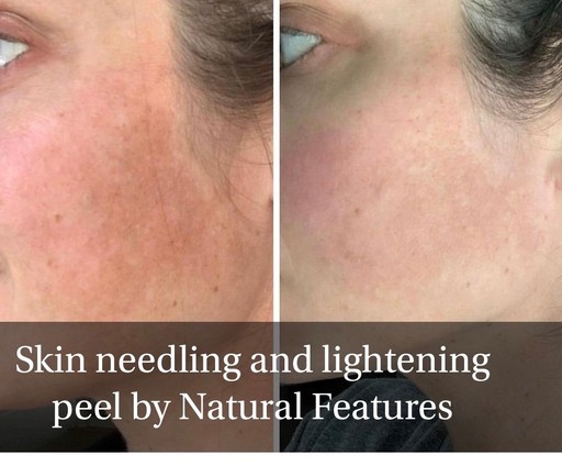 Skin needling by Natural Features Aesthetics Ltd