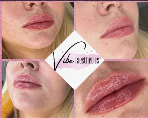 Lip Fillers