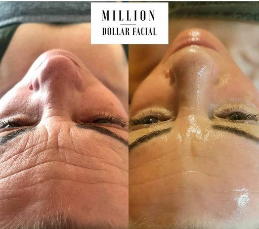 Million Dollar Facial